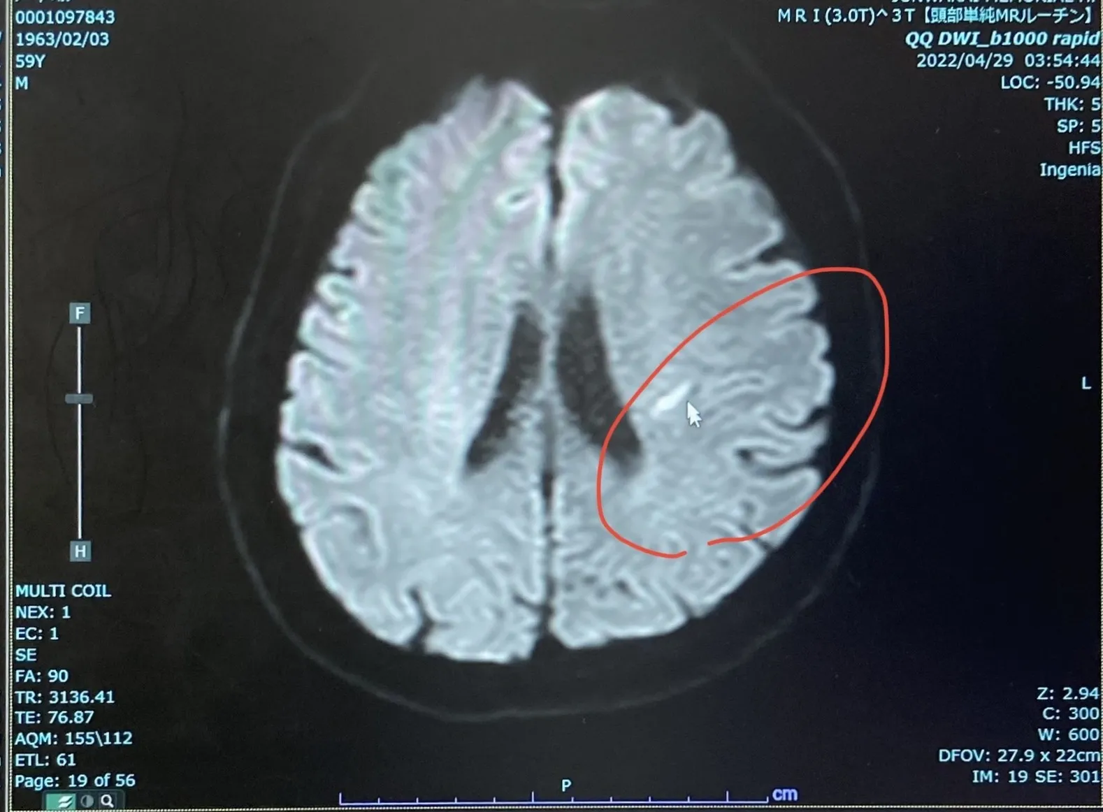 脳梗塞で入院でしたのに2週間後には走れました。